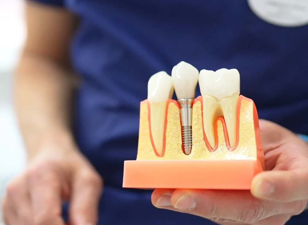 Comment maintenir un implant dentaire longtemps