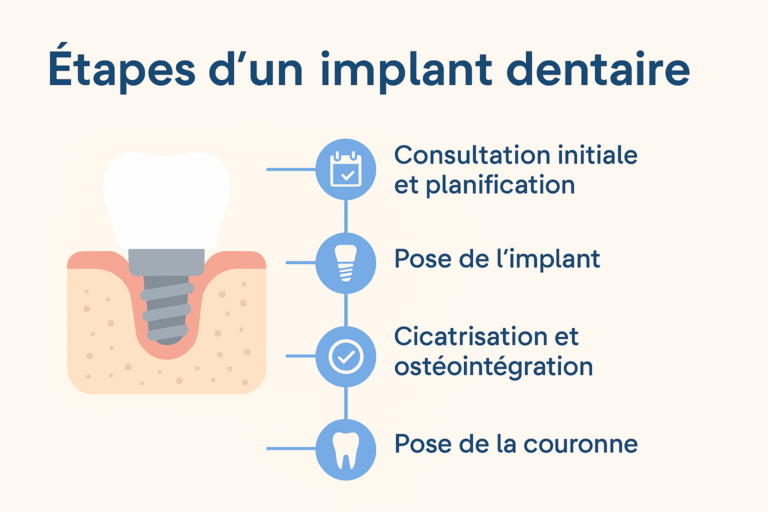 Illustration des étapes de la pose d’un implant dentaire
