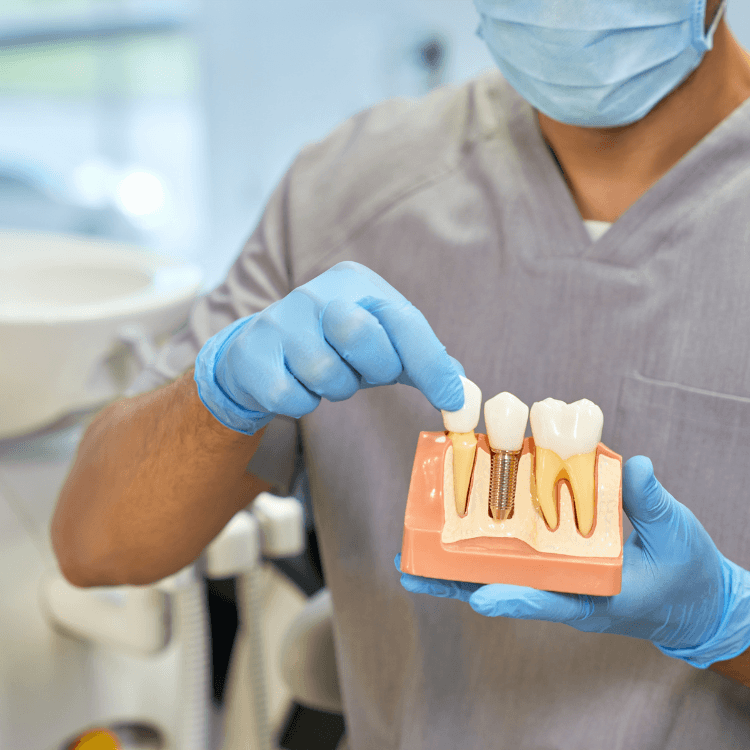 Implant dentaire inséré dans l’os de la mâchoire avec couronne prothétique